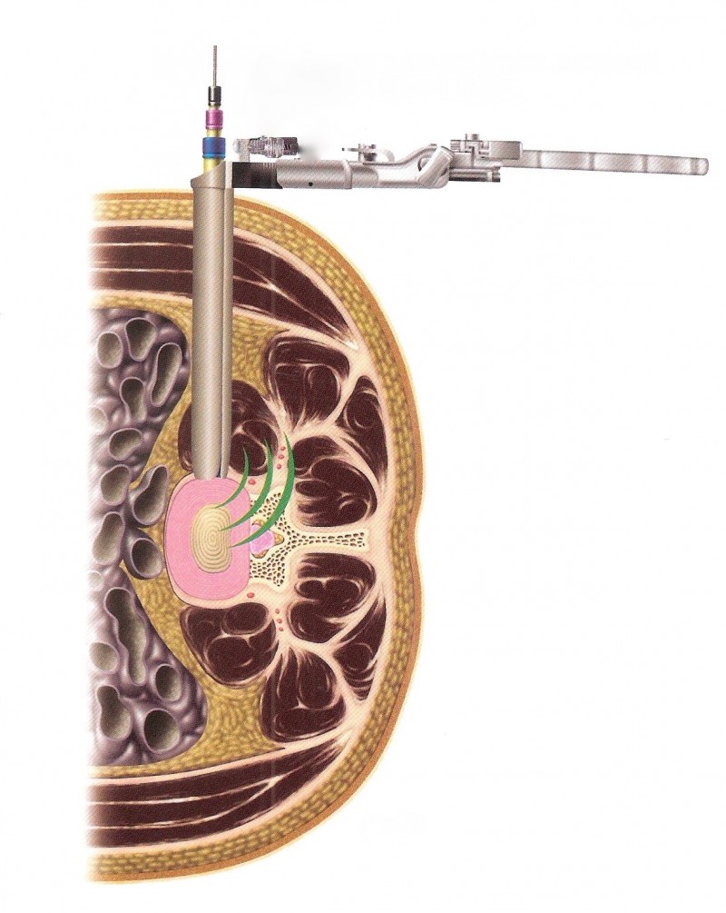 Extreme Lateral Minimally Invasive Fusion Xlif Spinecare Medical Group