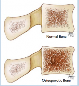 Osteoporosis & Osteoporotic Fractures - Spinecare Medical Group