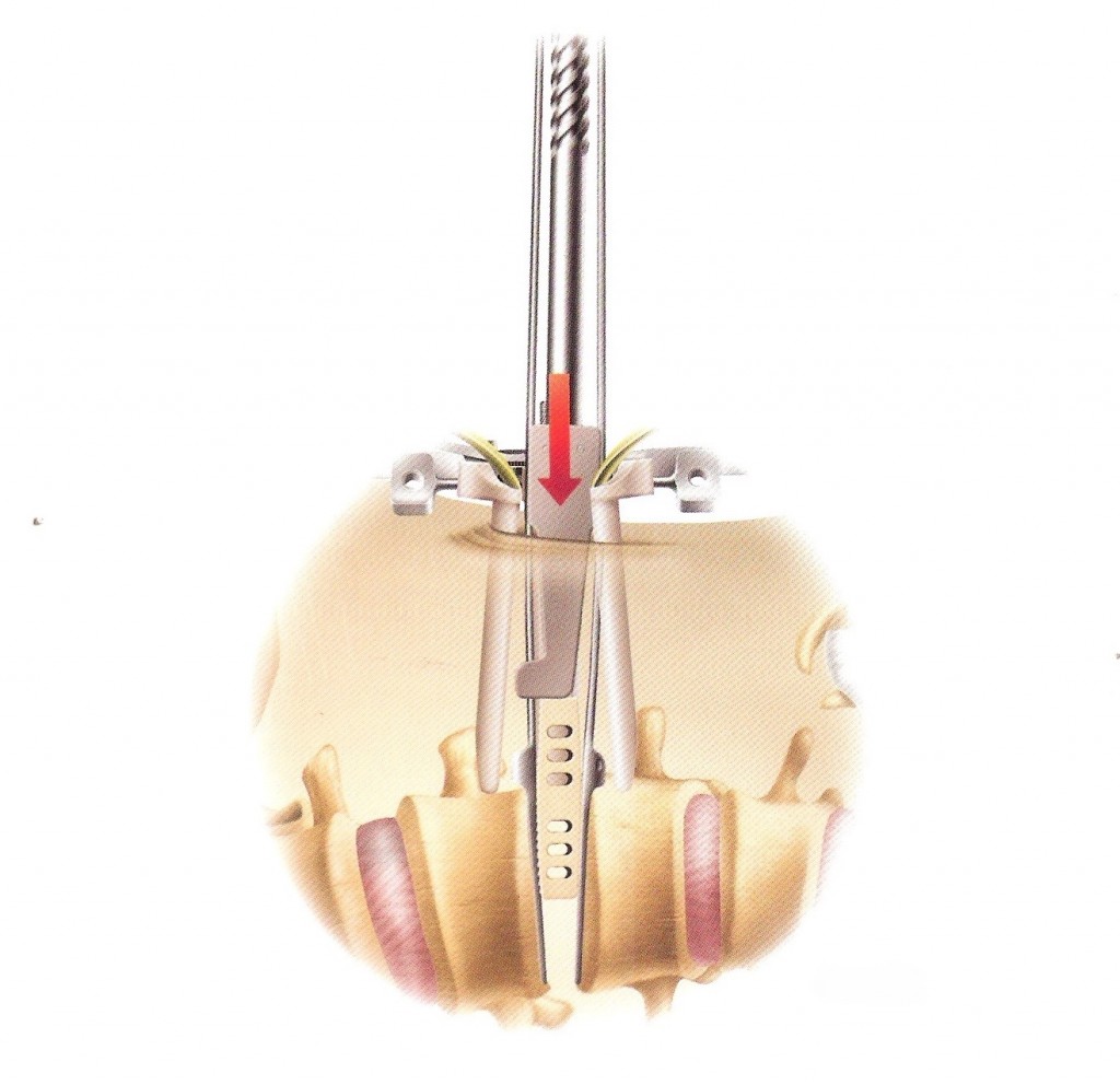 Extreme Lateral Minimally Invasive Fusion Xlif Spinecare Medical Group 7040