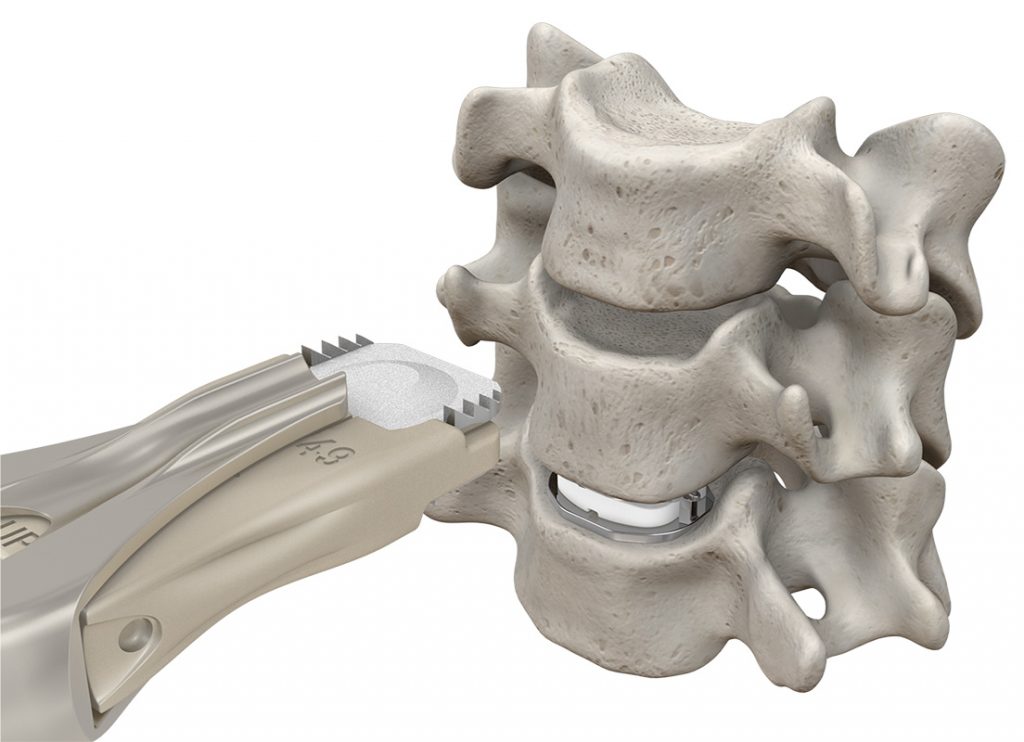 Mobi C Artificial Cervical Disc Replacement Spinecare Medical Group